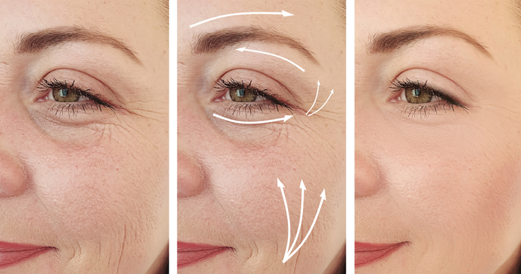 Kırışıklık Bakımları